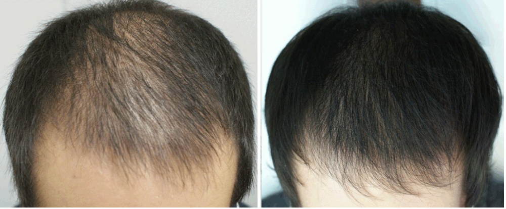 У мужчин диффузная алопеция также характеризуется рассеянным выпадением волос по всей голове