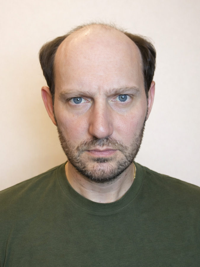 Before Hair System